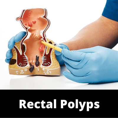 Bowel Movement -Rectal Polyps - Subcategories - Ailments Images