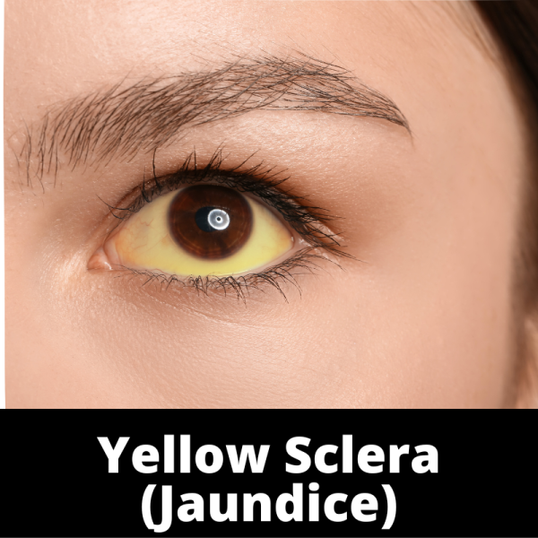Ailments Images - Category - Eyes - Yellow Sclera
