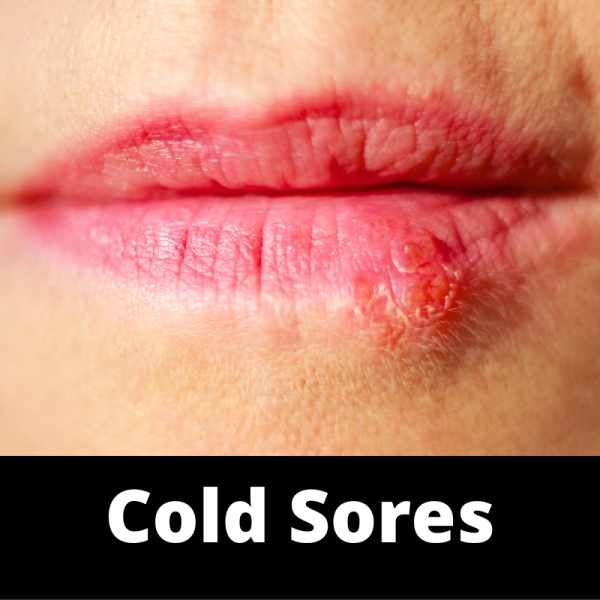 Sores Cold - Mouth - Ailments Images - Chinese Herbs